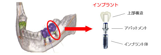 インプラントってなに？